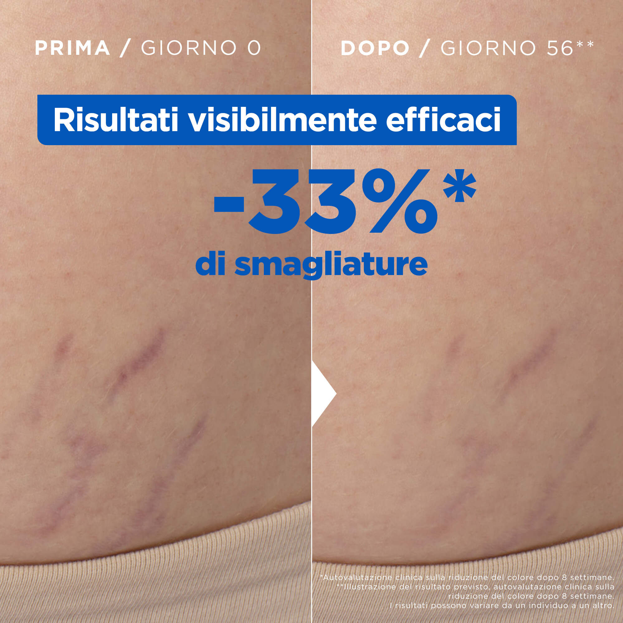 risultati prima e dopo olio smagliature Mixa