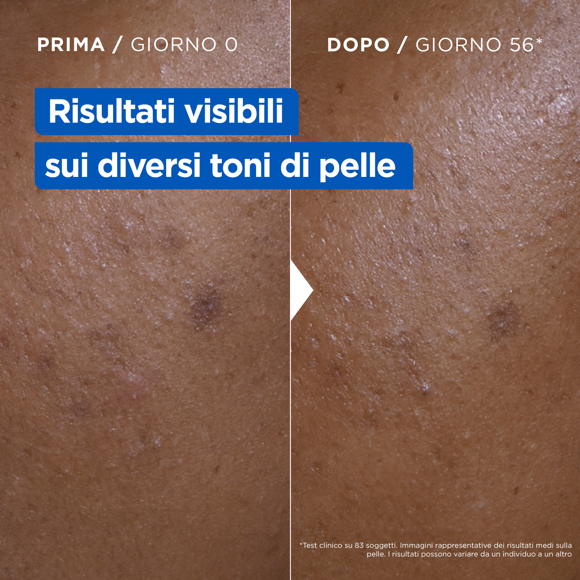 L'immagine mostra due fotografie di una pelle con diverse imperfezioni (prima) e la sua visibile riduzione (dopo)